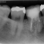 根尖性歯周炎の経過観察期間は最低４年必要です。