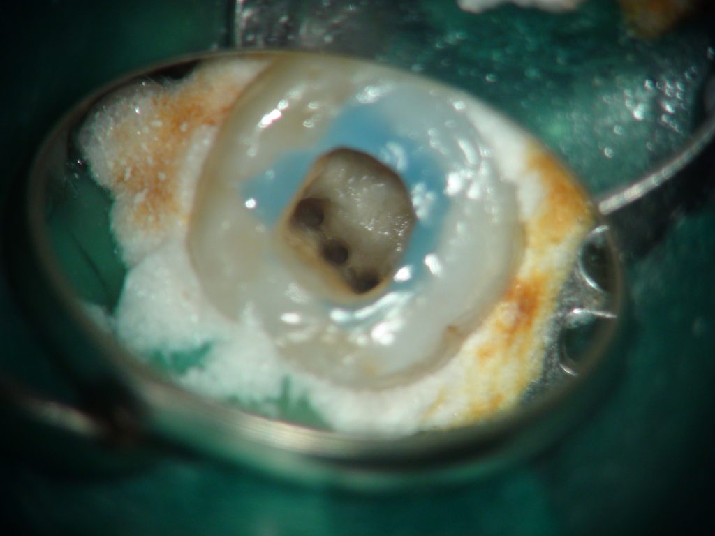 下顎第一大臼歯のMM根管