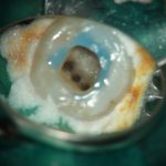 下顎第一大臼歯のMM根管の症例