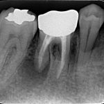歯内療法専門医としての出張診療