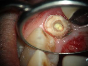 残存歯質が少ない症例