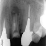 外科的歯内療法の経過観察＜術後3年＞